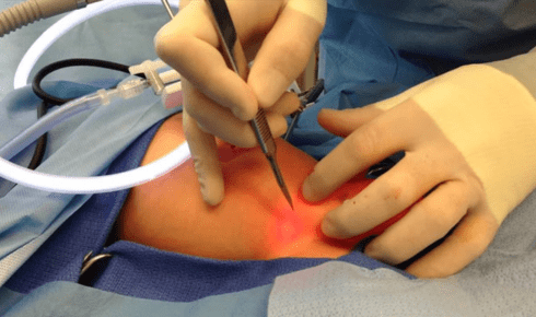 hernia repair surgery